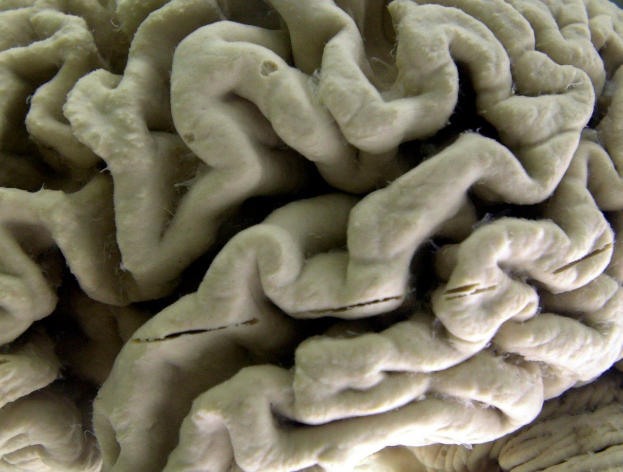 Blood Test May Predict Alzheimer's Risk in Healthy Seniors, Study Finds