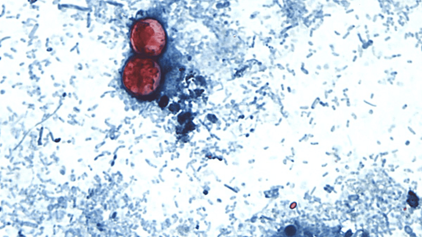 CDC Probes Parasitic Outbreak as U.S. Cyclosporiasis Cases Surge Past 1,600