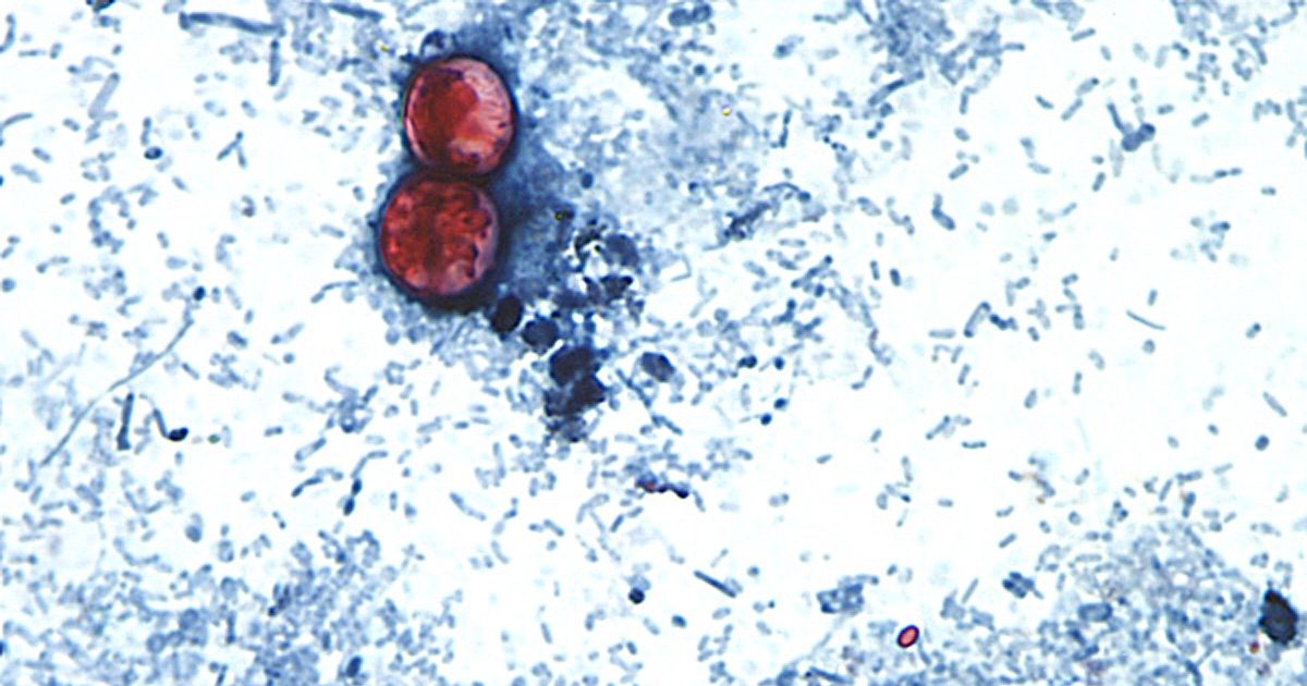 Cyclospora Outbreak Map: States Hit Hardest by Parasitic Illness