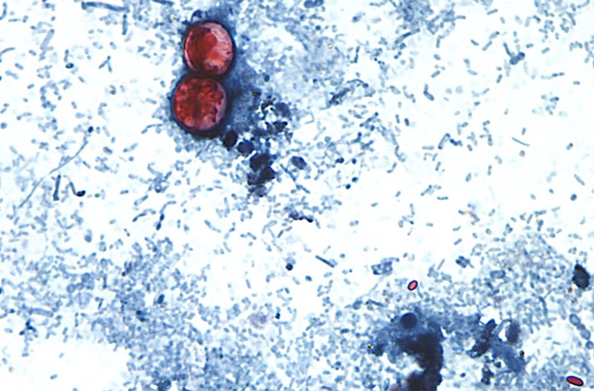 Cyclosporiasis Outbreak Surpasses 18,200 Suspected Cases, Michigan Hardest Hit