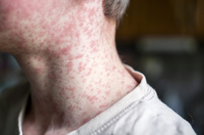 Measles Surge in 2026 Is Worst US Outbreak in Over Three Decades