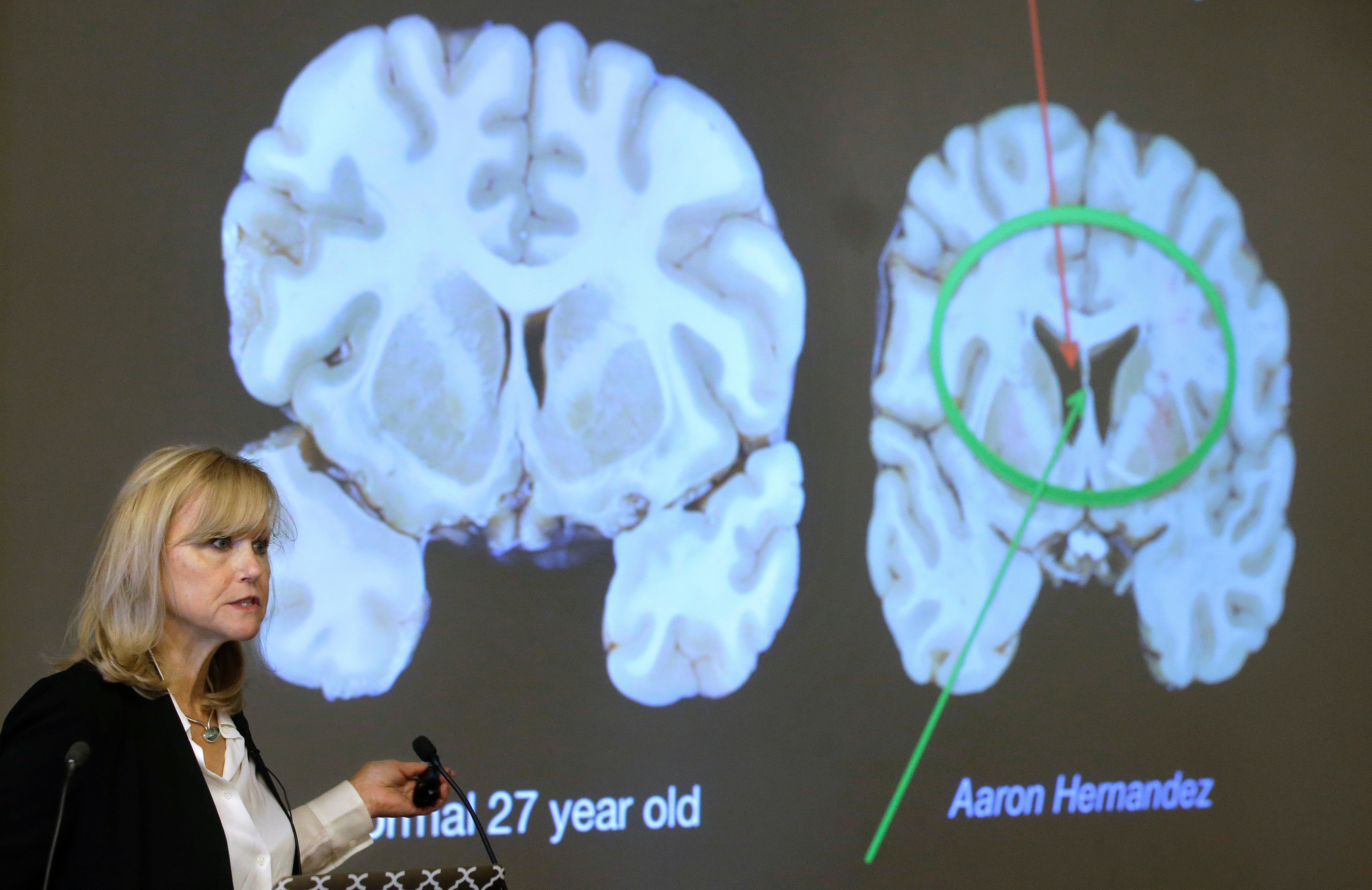 NFL Faces Scrutiny as Study Finds 1 in 4 Players Develop CTE