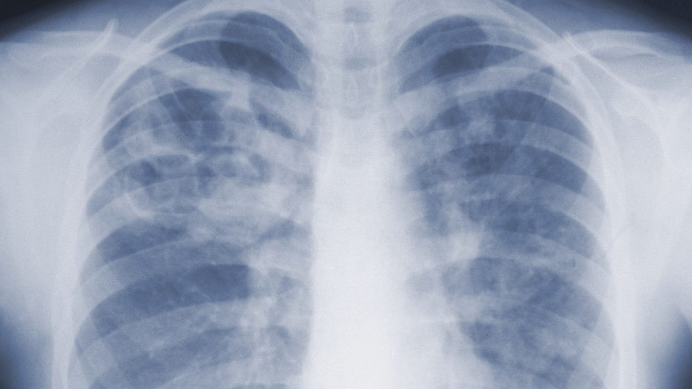 Pneumonic plague risk: What to know after Russian lab worker death