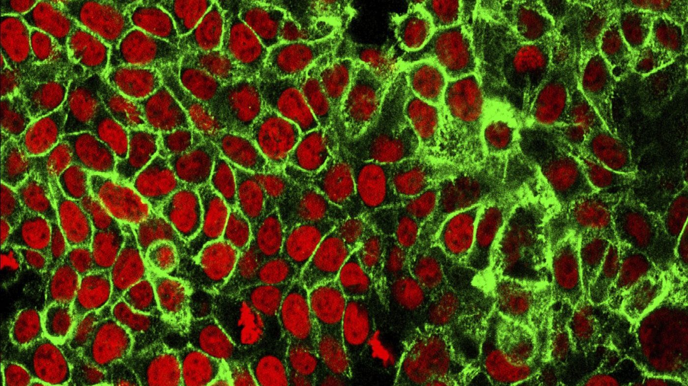 Young Adult Colorectal Cancer Cases Surge, Challenging Screening Guidelines